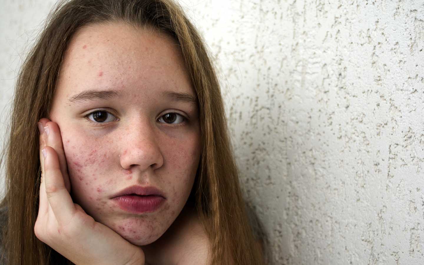Teenager mit Akne