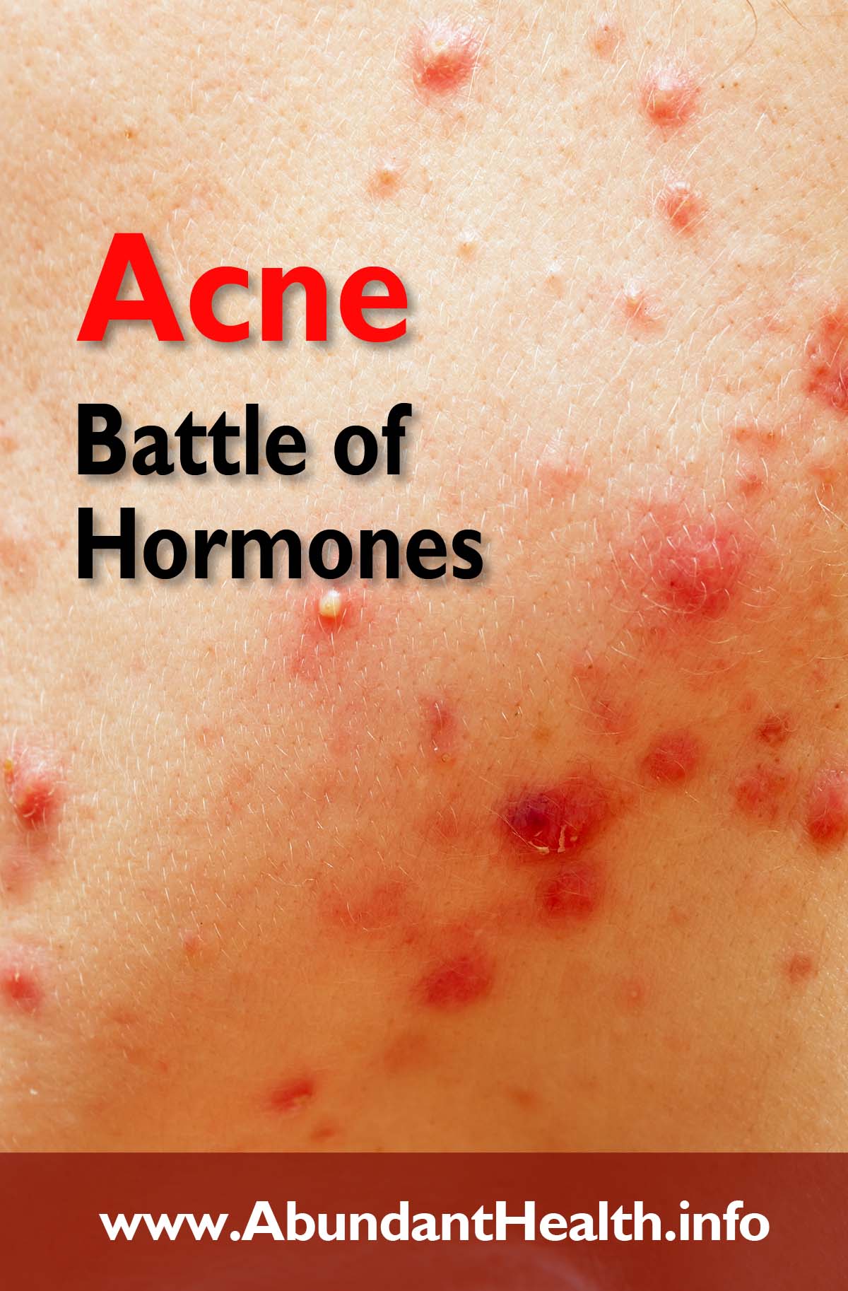 Acne - Battle of Hormones