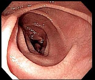 Endoskopie von einem Zwölffingerdarm mit Zöliakieschäden - Foto by Samir from Wikipedia
