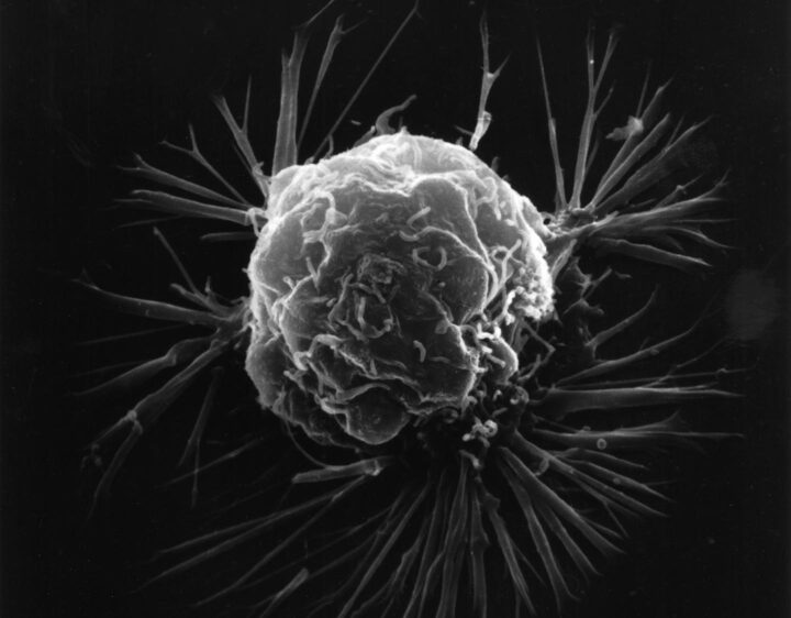 Cancer cell under electon microscope