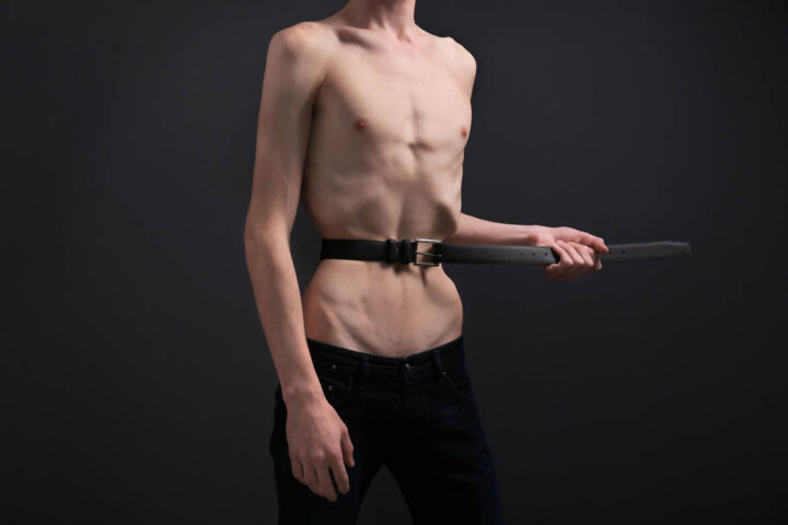 A malnourished man with anorexia