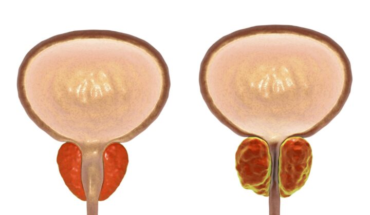 A normal prostate compared to benign prostate hyperplasia