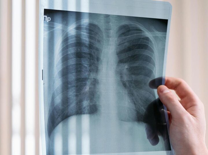 An X-ray image of a smoker's lung with lung cancer