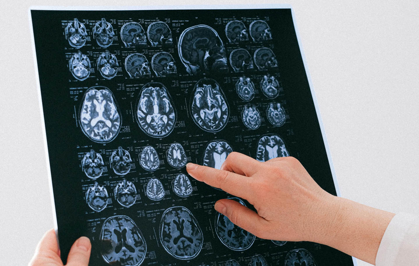 Reversing Brain Damage of Chronic Stress