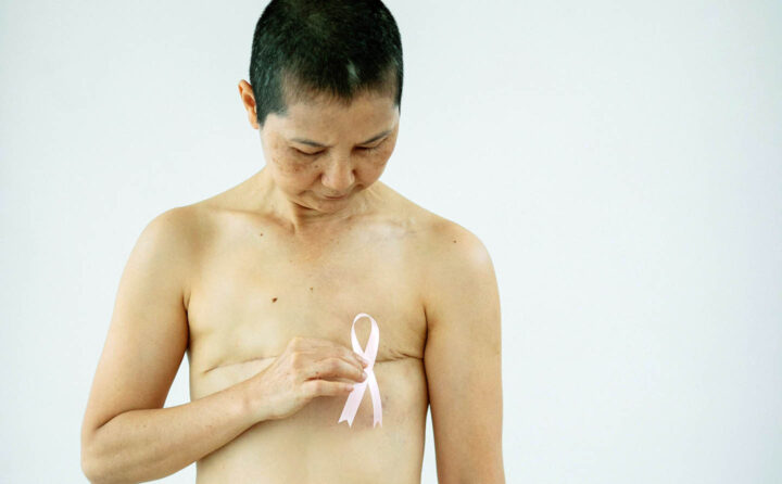 A woman with 2 breasts operated because of cancer