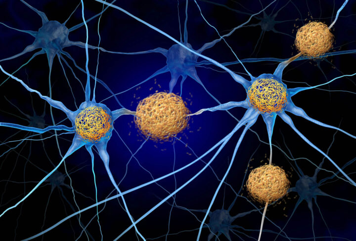Tau Tangles And Amyloid Beta conceptual illustration